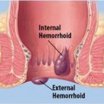 hemoroid