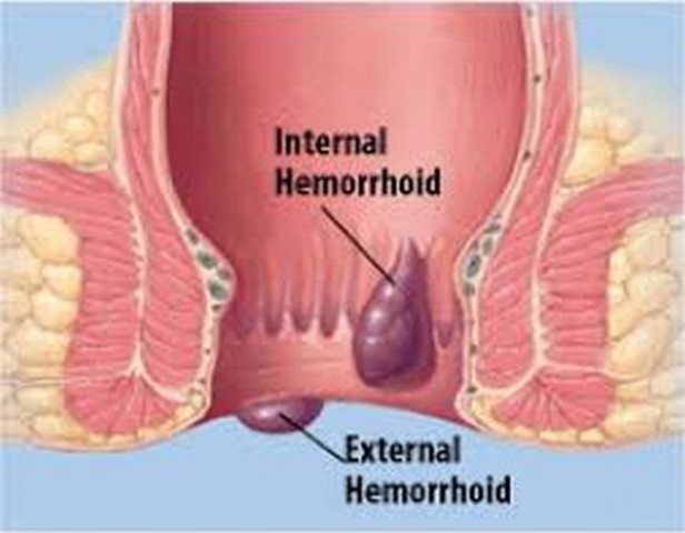 hemoroid